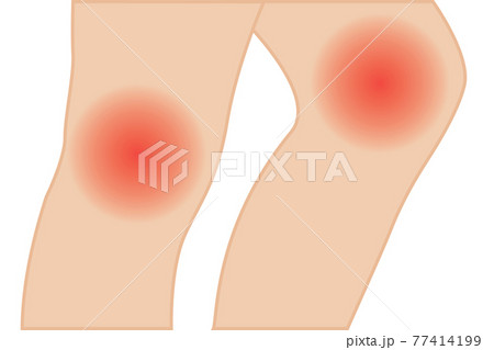 Knee joint pain vector illustration. hyperextension treatment 77414199