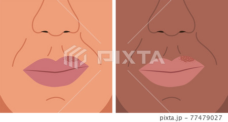 Vector illustration of herpes on the lip, cold sore, herpes simplex. 77479027