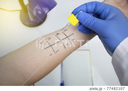 An allergist doctor in the laboratory conducts a prik allergy test. Skin test for household, food, epidermal allergic reactions An allergist doctor in the laboratory conducts a prik allergy test. Skin test for household, food, epidermal allergic reactions 77482107