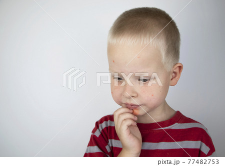 An allergist or dermatologist examines red spots on a child face. The boy suffers from a rash, hives and itching. Food Allergy, Insect Bite, Measles or Chicken Pox An allergist or dermatologist examines red spots on a child face. The boy suffers from a rash, hives and itching. Food Allergy, Insect Bite, Measles or Chicken Pox 77482753