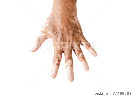 Close-up Vitiligo on skin hands of old people. medical condition causing depigmentation of patches of skin. isolated White background 77499503