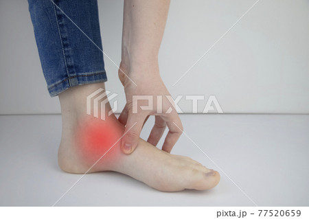 Woman suffering from heel pain. Inflammation or sprain of the tendon in the foot, heel spur, bursitis. The concept of diseases and pains in the leg 77520659