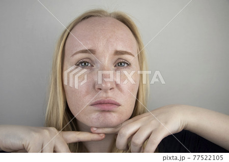 Oily and problem skin. Portrait of a blonde girl with acne, oily skin and pigmentation 77522105