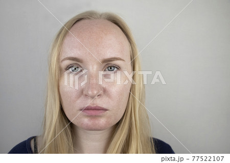 Oily and problem skin. Portrait of a blonde girl with acne, oily skin and pigmentation 77522107