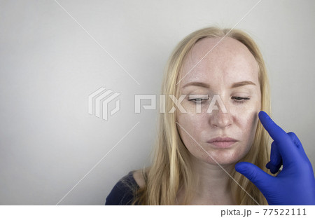 Oily and problem skin. Portrait of a blonde girl with acne, oily skin and pigmentation Oily and problem skin. Portrait of a blonde girl with acne, oily skin and pigmentation 77522111