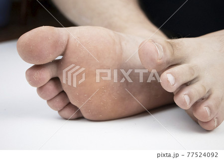 Fungus on the leg close-up isolated on a white background. The concept of dermatology, the treatment of fungal infections and ringworm. Macro photo of human parasites on the foot of a man. 77524092