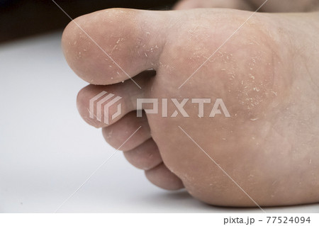 Fungus on the leg close-up isolated on a white background. The concept of dermatology, the treatment of fungal infections and ringworm. Macro photo of human parasites on the foot of a man. 77524094