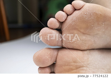 Fungus on the leg close-up isolated on a white background. The concept of dermatology, the treatment of fungal infections and ringworm. Macro photo of human parasites on the foot of a man. Fungus on the leg close-up isolated on a white background. The concept of dermatology, the treatment of fungal infections and ringworm. Macro photo of human parasites on the foot of a man. 77524122