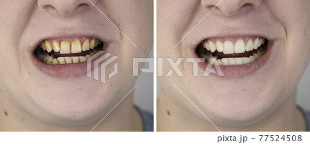 Teeth of a man before and after bleaching. The dentist removed yellow plaque from tooth enamel. The concept of professional toothbrushing in a dental clinic 77524508