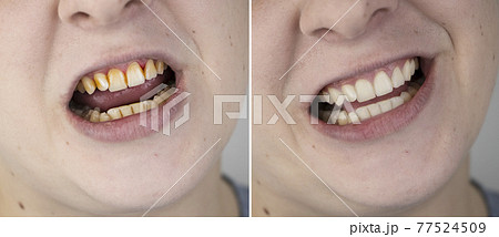 Teeth of a man before and after bleaching. The dentist removed yellow plaque from tooth enamel. The concept of professional toothbrushing in a dental clinic Teeth of a man before and after bleaching. The dentist removed yellow plaque from tooth enamel. The concept of professional toothbrushing in a dental clinic 77524509