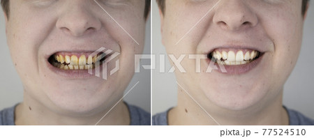 Teeth of a man before and after bleaching. The dentist removed yellow plaque from tooth enamel. The concept of professional toothbrushing in a dental clinic 77524510