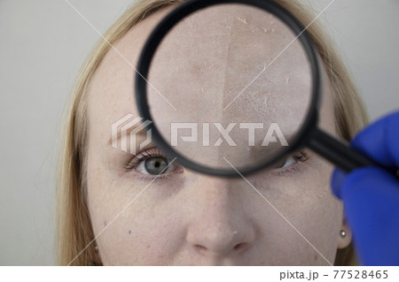 A woman examines dry skin on her face. Peeling, coarsening, discomfort, skin sensitivity. Patient at the appointment of a dermatologist or cosmetologist, selection of cream for dryness A woman examines dry skin on her face. Peeling, coarsening, discomfort, skin sensitivity. Patient at the appointment of a dermatologist or cosmetologist, selection of cream for dryness 77528465