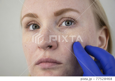 A woman examines dry skin on her face. Peeling, coarsening, discomfort, skin sensitivity. Patient at the appointment of a dermatologist or cosmetologist, selection of cream for dryness 77528468