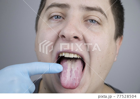 White curd on the tongue. A physician or gastroenterologist examines a man tongue. Patient has poor oral hygiene or a symptom of illness White curd on the tongue. A physician or gastroenterologist examines a man tongue. Patient has poor oral hygiene or a symptom of illness 77528504