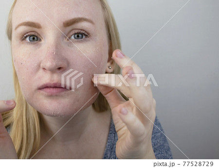 A woman examines dry skin on her face. Peeling, coarsening, discomfort, skin sensitivity. Patient at the appointment of a dermatologist or cosmetologist, selection of cream for dryness A woman examines dry skin on her face. Peeling, coarsening, discomfort, skin sensitivity. Patient at the appointment of a dermatologist or cosmetologist, selection of cream for dryness 77528729