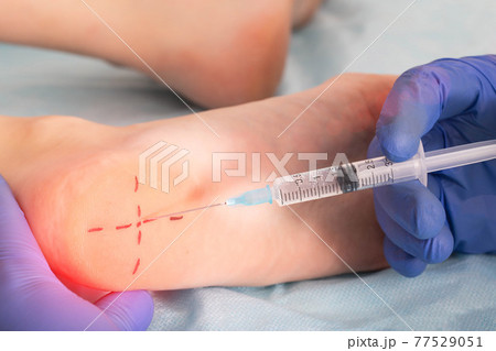 Medical injection with a medicine in the heel of the patient's foot with a heel spur disease, an osteophyte growth, close-up Medical injection with a medicine in the heel of the patient's foot with a heel spur disease, an osteophyte growth, close-up 77529051