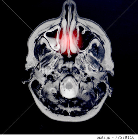 Magnetic resonance imaging of a patient with bad nose breathing, nasal congestion. The concept of hyperplasia of the ethmoid cell mucosa, otolaryngology 77529116
