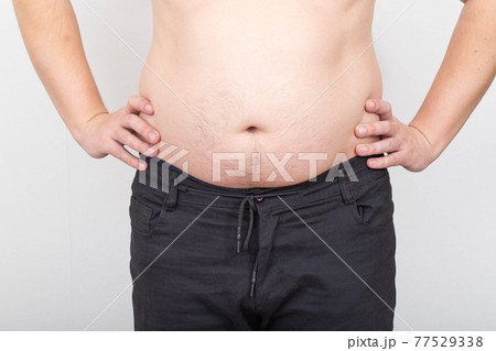 A man with a fat and flabby belly on a white background. Obesity and obesity concept, wrong lifestyle 77529338