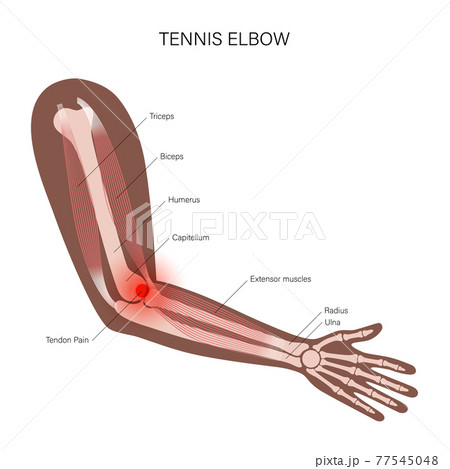 Lateral epicondylitis tennis elbow 77545048