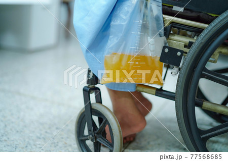 Asian middle-aged lady woman patient sitting on wheelchair with urine bag in the hospital ward 77568685