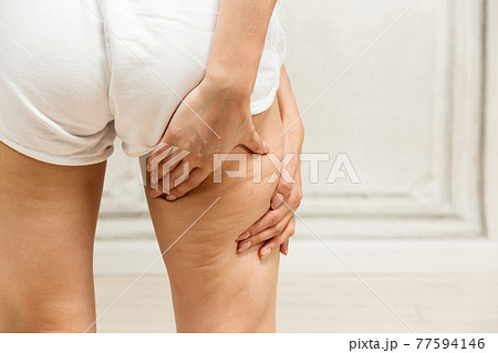 太もものセルライト / 若い女性 77594146