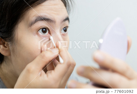 Asian woman has eye pain,irritation problem from dust,insect or eyelash falling into the eyes,girl removing dirt using a cotton bud swab to wipe clean the itchy area or treating a sore eye,health care 77601092