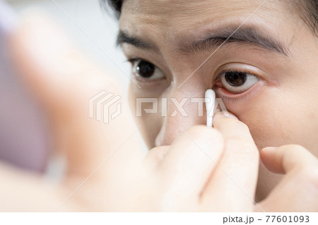 Female using a cotton bud swab to wipe clean the swollen,itchy area,problems of eyelid is rolled inward against the eyeball,introversion of the eyelashes or irritation of the eye from false eyelashes Female using a cotton bud swab to wipe clean the swollen,itchy area,problems of eyelid is rolled inward against the eyeball,introversion of the eyelashes or irritation of the eye from false eyelashes 77601093