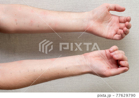 Hands with positive allergy tests. Allergy tests on the arms. 77629790