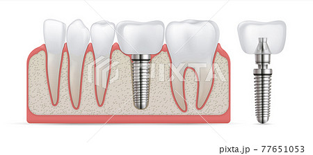 Dental implant. Teeth care surgery and crown fixture. Tooth replacement and prosthesis treatment. Implantation of artificial molar with metal screw. Denture model. Vector stomatology 77651053