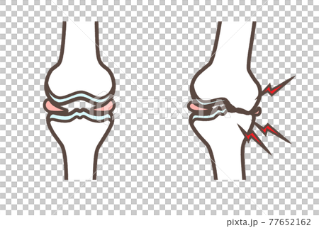 Illustration of knee osteoarthritis - Stock Illustration [77652162] - PIXTA
