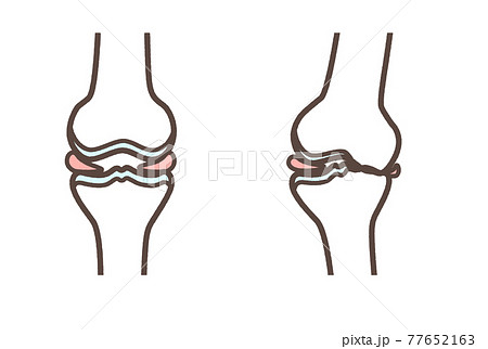 ひざの関節のイラスト 77652163