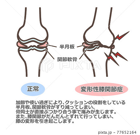 変形性膝関節症　図解 77652164