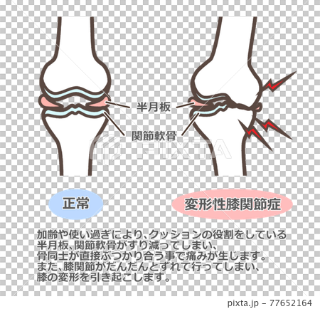 変形性膝関節症　図解 77652164