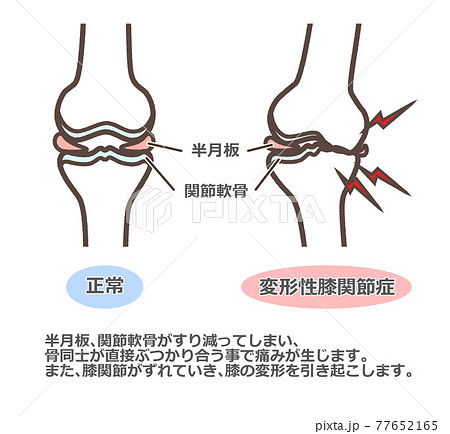 変形性膝関節症 解説ありのイラスト素材