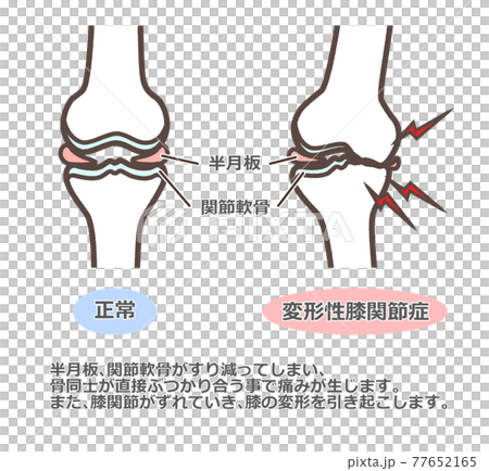 変形性膝関節症　解説あり 77652165