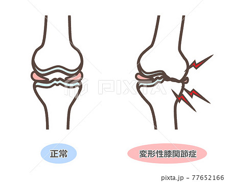 変形性膝関節症のイラストのイラスト素材