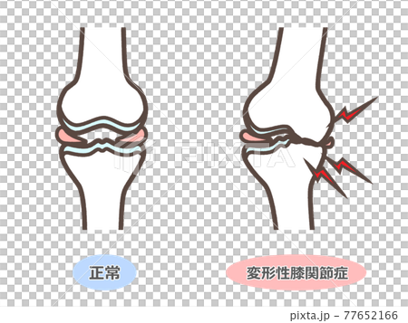 Illustration of knee osteoarthritis 77652166