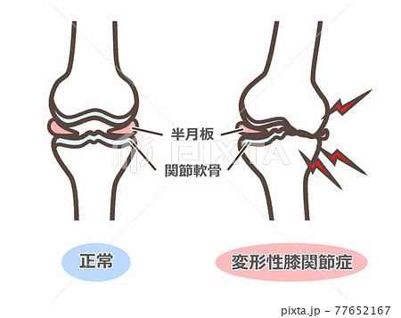 変形性膝関節症のイラストのイラスト素材