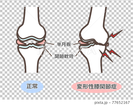 変形性膝関節症のイラスト 77652167