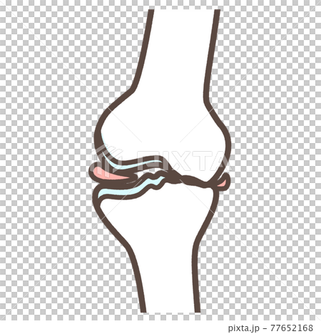 変形性膝関節症のイラスト 変形性膝関節症のイラスト 77652168