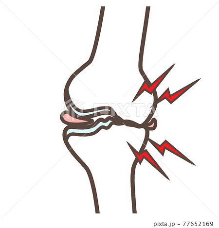 変形性膝関節症のイラスト 77652169