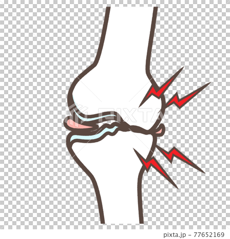 変形性膝関節症のイラストのイラスト素材