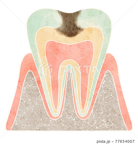 虫歯になった歯の断面（C2）のイラスト素材 [77654007] - PIXTA