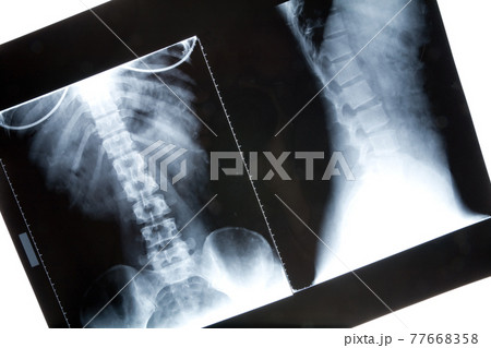 x-ray image x-ray image 77668358