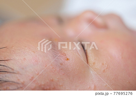 新生児の乳児湿疹 新生児の乳児湿疹 77695276