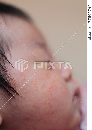 新生児の乳児湿疹の写真素材
