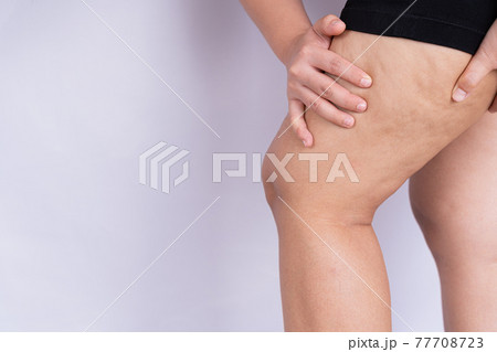Female holding and pushing the skin of the legs cellulite or orange peel. Treatment and disposal of excess weight, the deposition of subcutaneous fat tissue Female holding and pushing the skin of the legs cellulite or orange peel. Treatment and disposal of excess weight, the deposition of subcutaneous fat tissue 77708723
