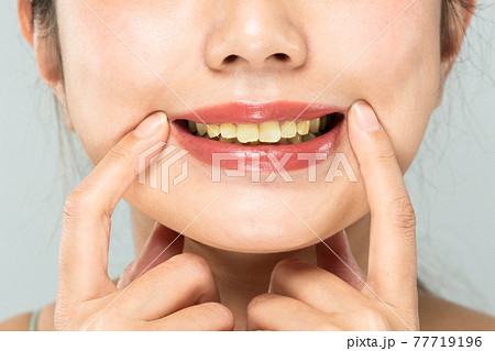 黄ばんだ歯 77719196