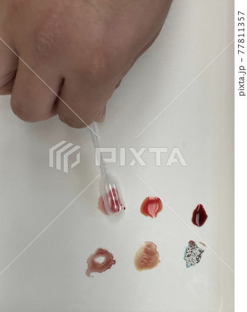 Medical doctor performing a quick blood group determination by using blood type testing kit with anti A and B antibodies on a white card. 77811357