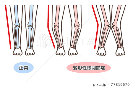変形性膝関節症　図解 77819670